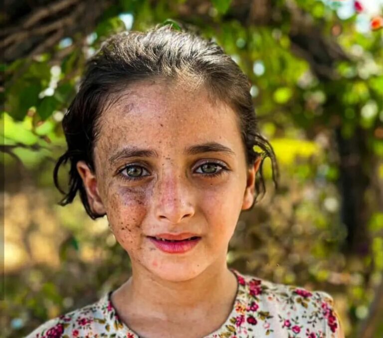 مها… الناجية الوحيدة من ليلٍ ابتلع عائلتها وترك الحروق شاهدة